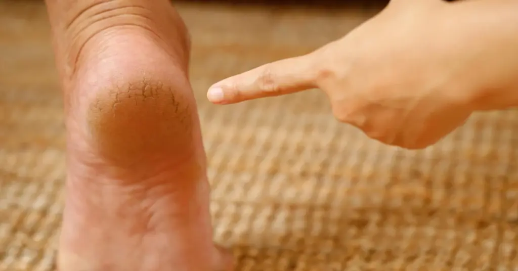durezas talon pie